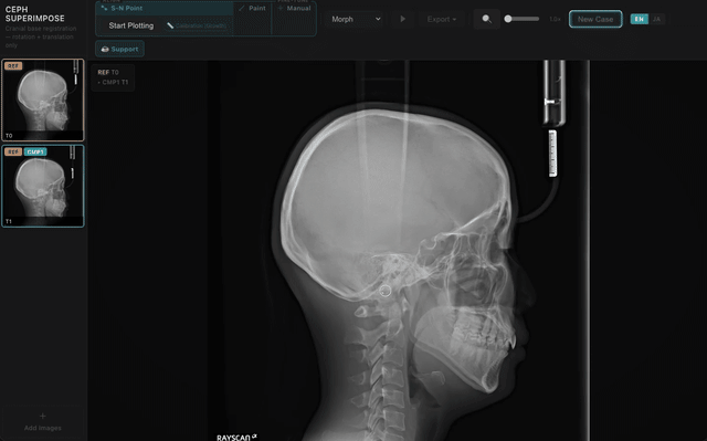 Cephalometric superimposition toggle animation